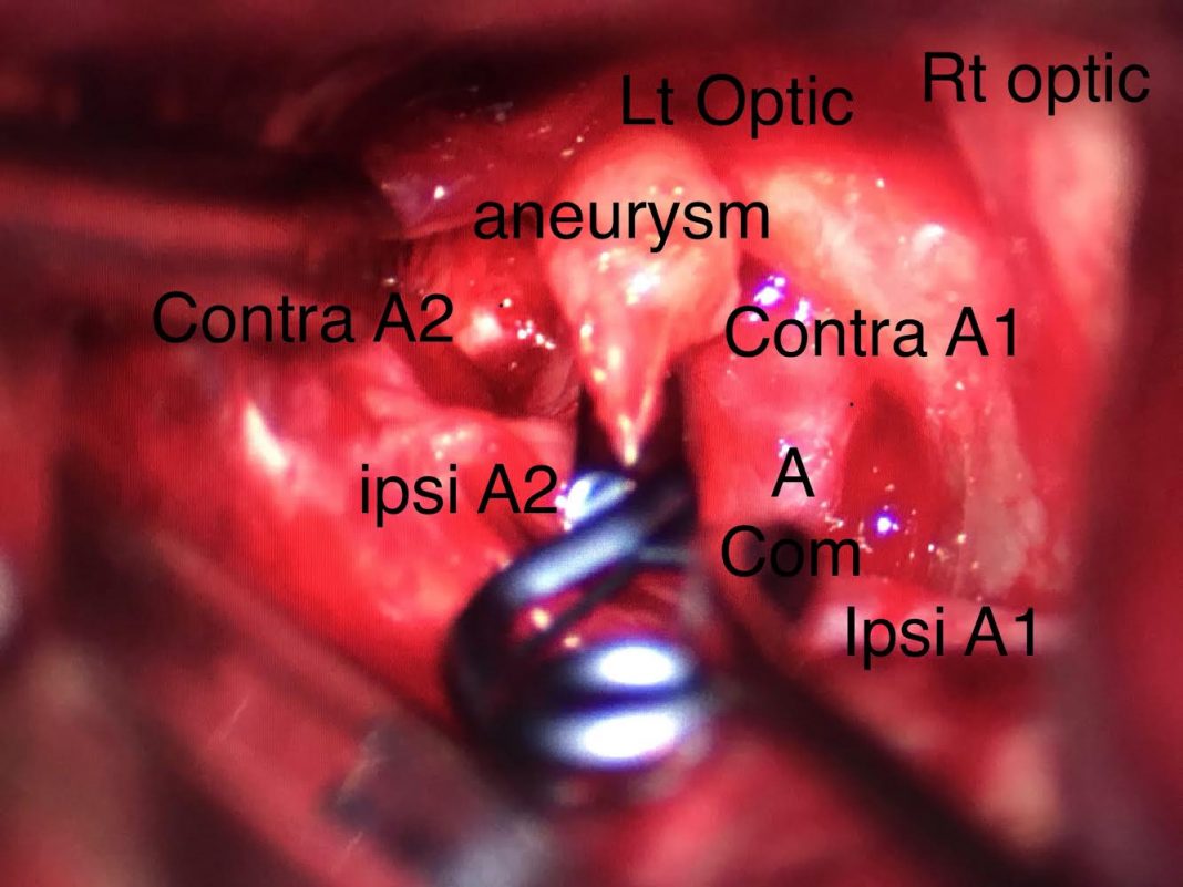 traumatic brain injury