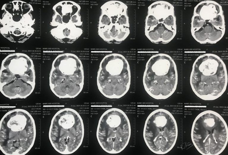 IntraCranial Meningioma.