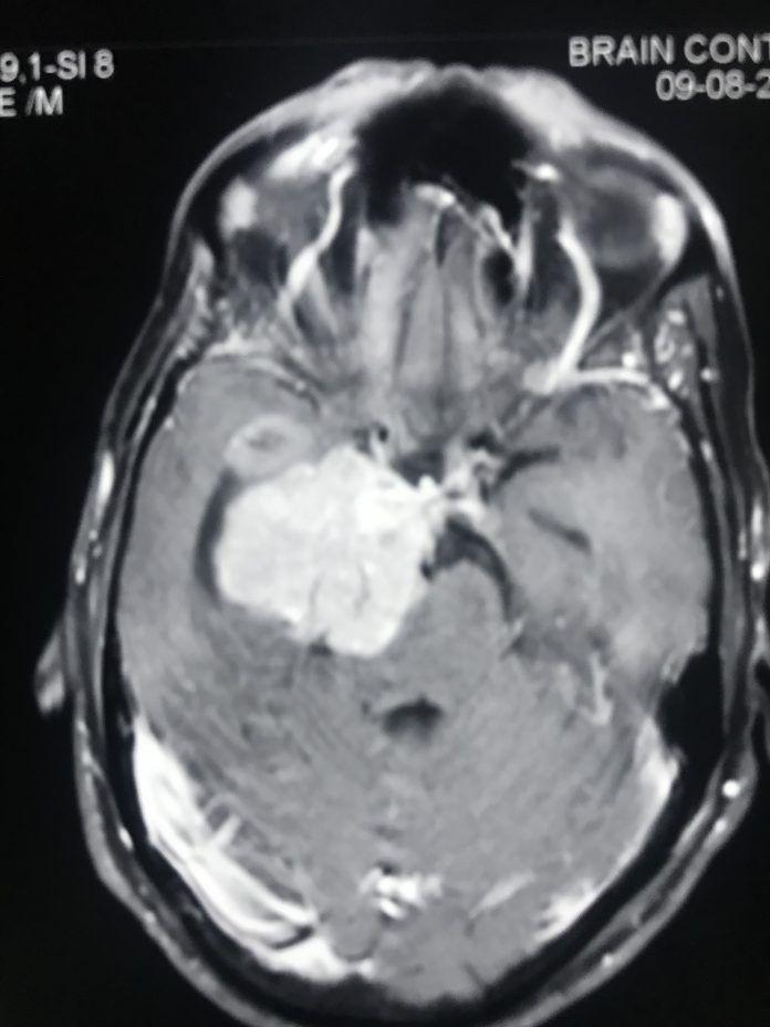 Clinoidal Meningioma