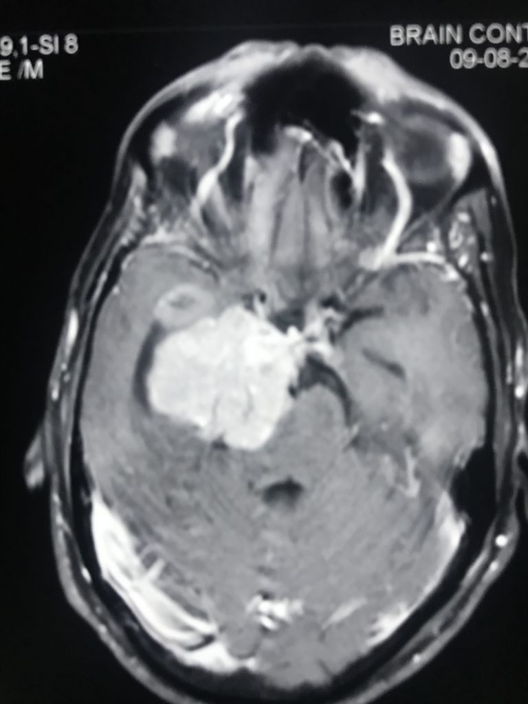 Clinoidal Meningioma