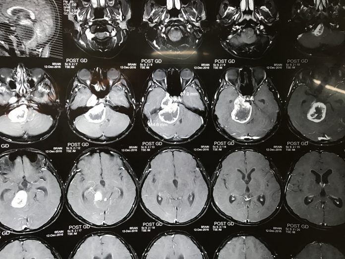 Intracranial Meningiomas
