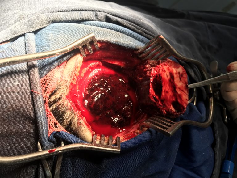 traumatic brain injury