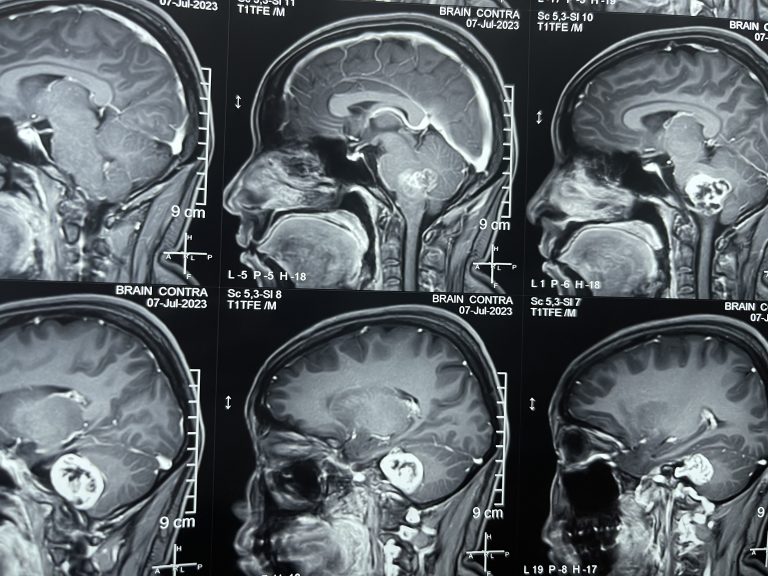 Pediatric Brain Tumors