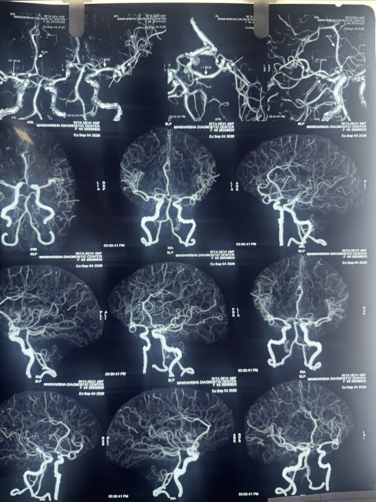 7 Aneurysms: Clipping of bilateral aneurysms through one approach.