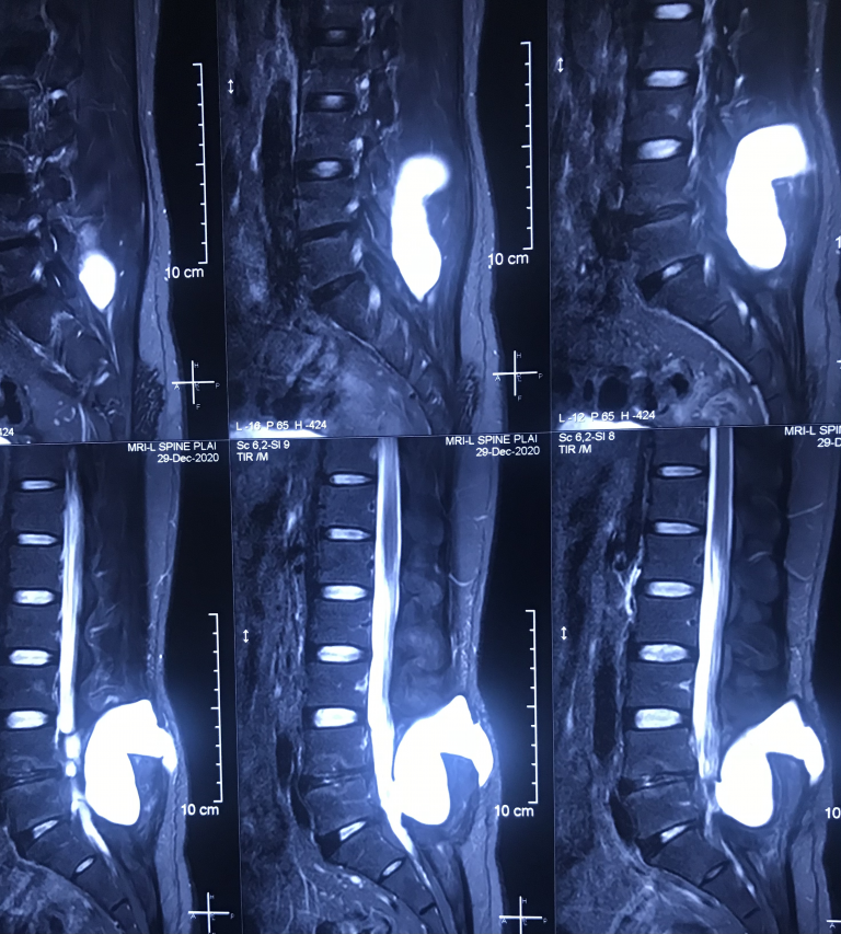 Giant Spinal Pseudomeningocele
