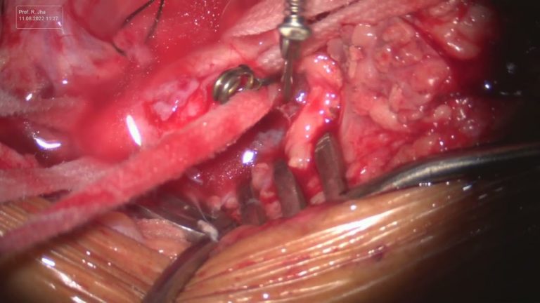 Carotid Endarterectomy (CEA) – Part 7