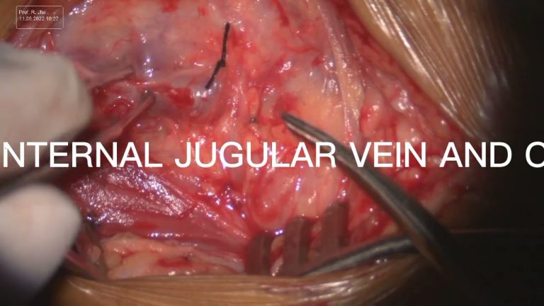 Carotid Endarterectomy (CEA) – Part 2