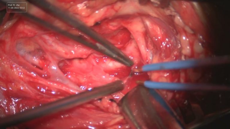 Carotid Endarterectomy (CEA) – Part 4
